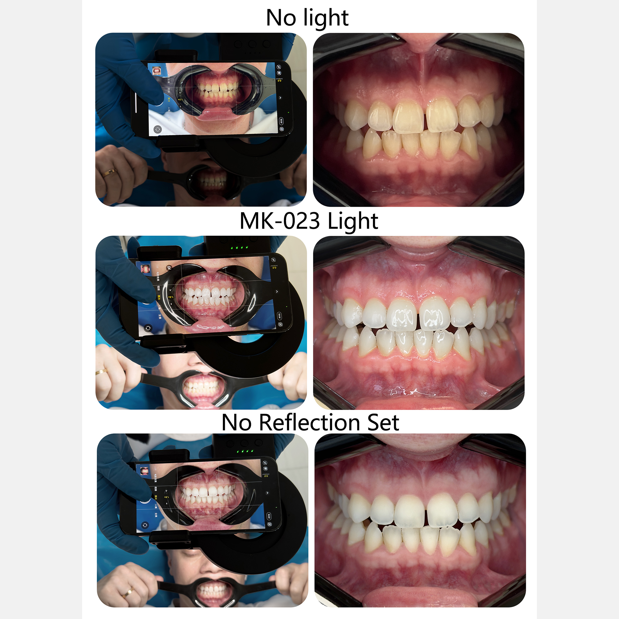 HERA MK-23 Intraoral Dental Ph - Photography Lighting Ring のレビューと価格